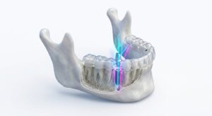 디지털 치과 가이드 시스템의 3D 시뮬레이션 구조